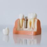 What Influences the Price of Dental Implants in the UK?