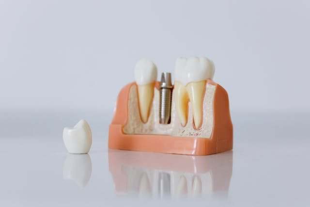 What Influences the Price of Dental Implants in the UK?